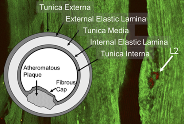 Atheromatous Plaque