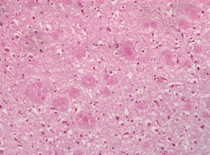 Amyloid plaques