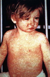 child-with-measles
